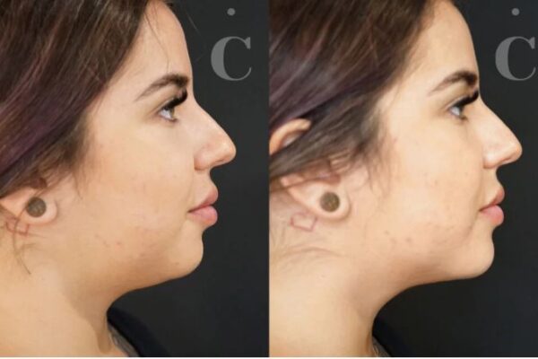 Chin Filler Before and After