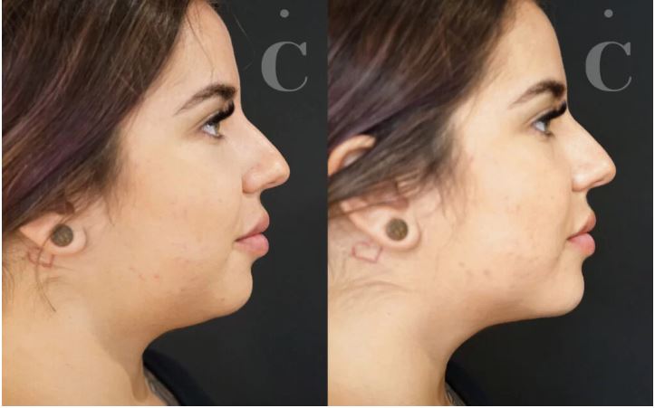 Chin Filler Before and After